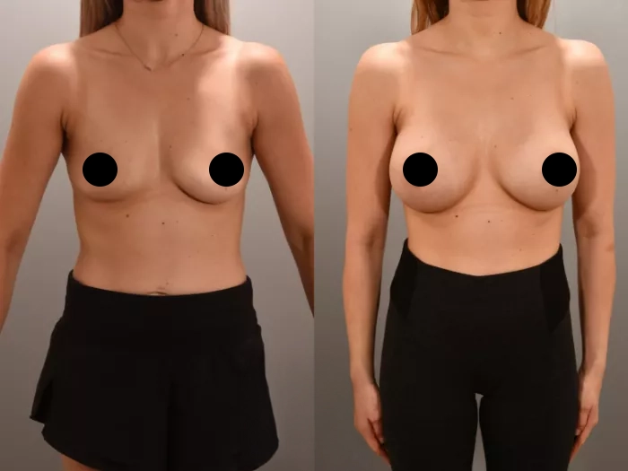 Augmentation-1