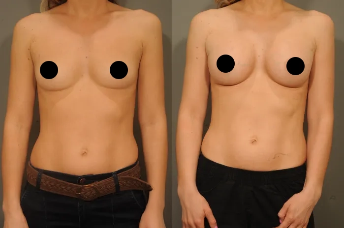 Augmentation3