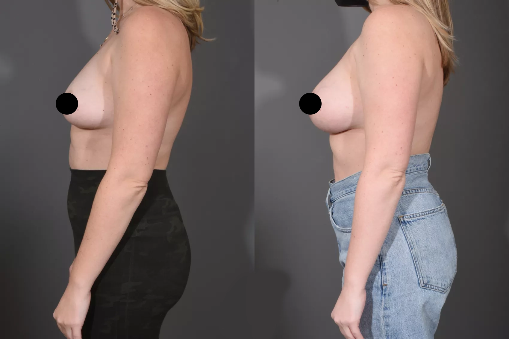 Augmentation6