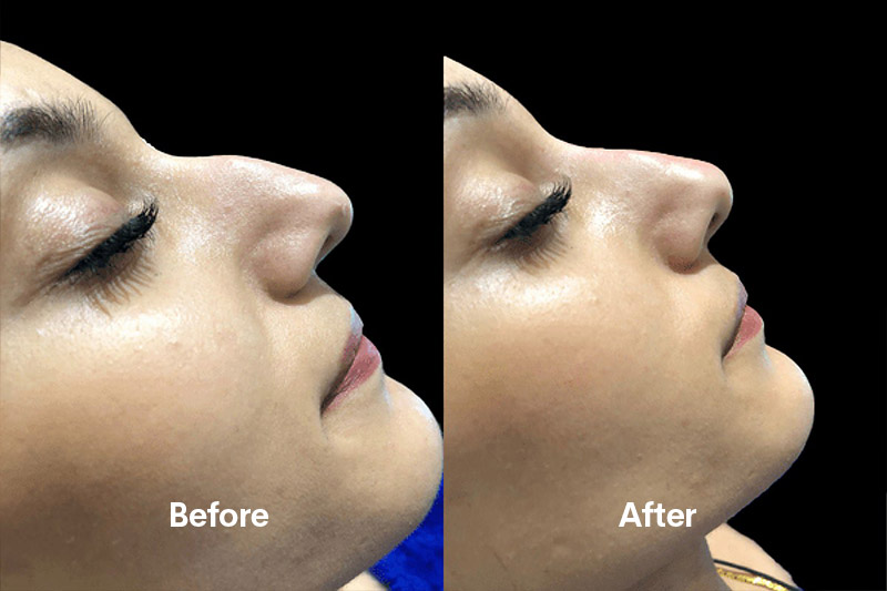 Rhinoplasty-1
