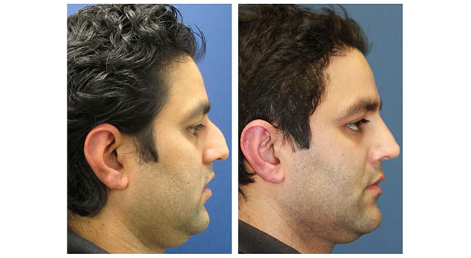Rhinoplasty-4