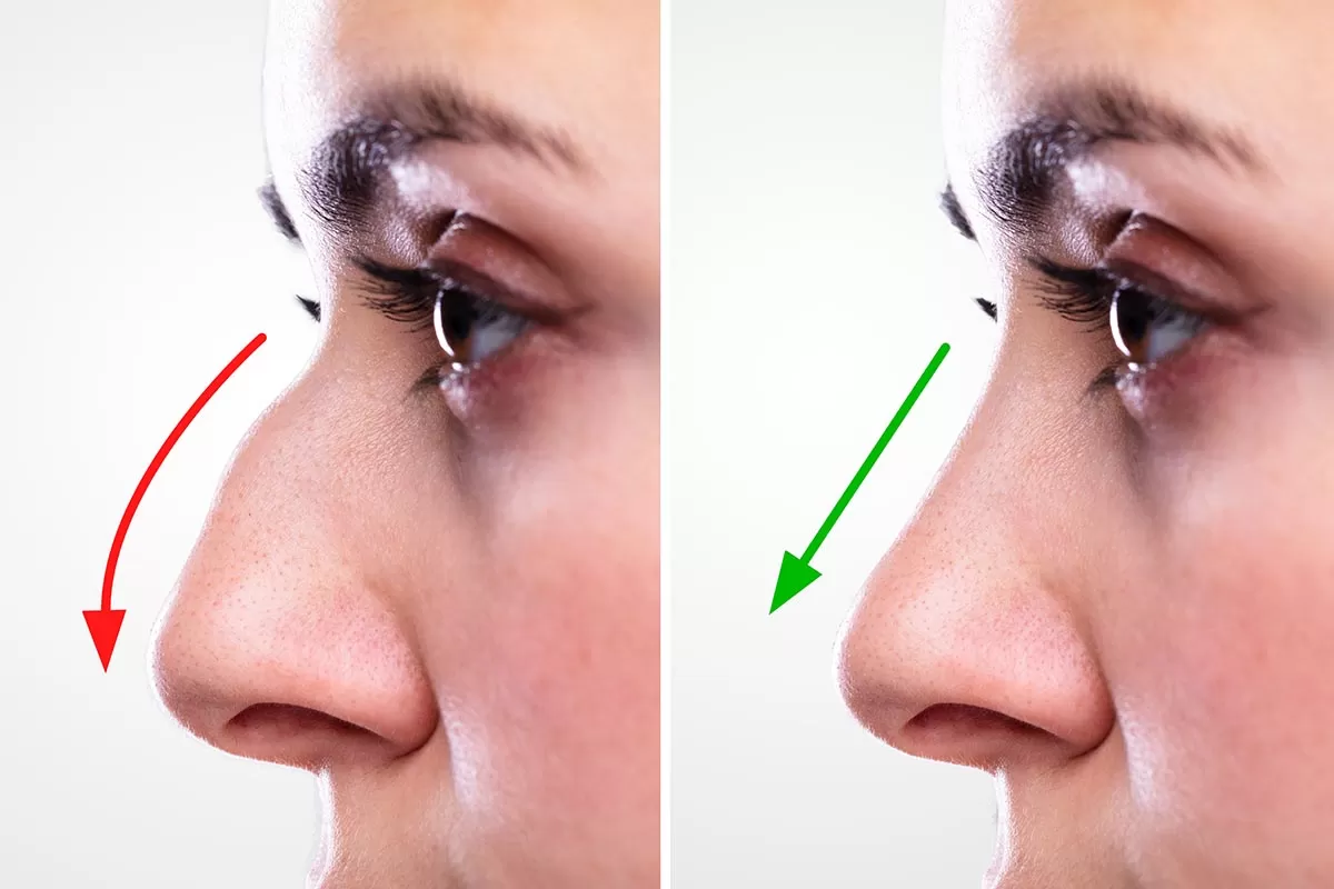 Rhinoplasty-6
