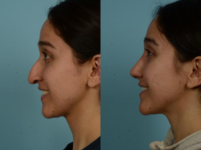 Rhinoplasty-7