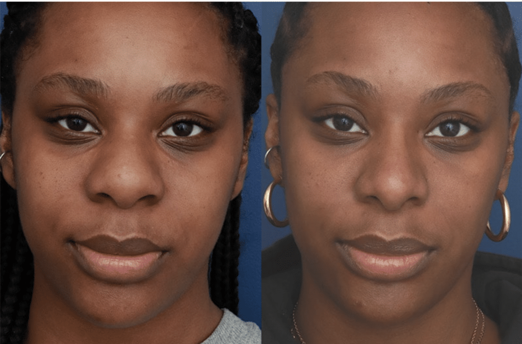 Rhinoplasty-8