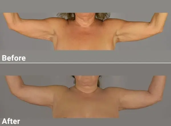 arm4