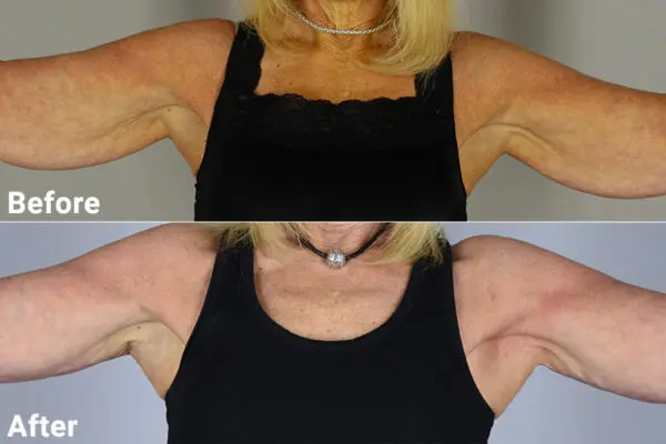arm6