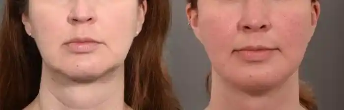 buccal2