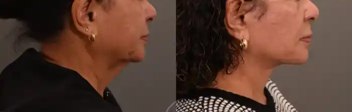 buccal3