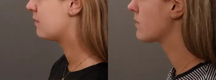 buccal6