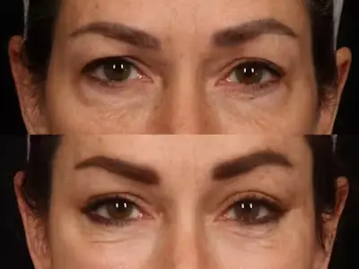 eyelid2