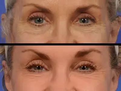 eyelift5