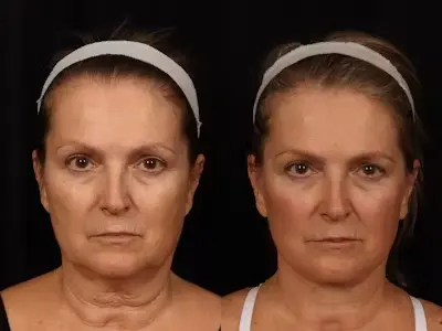 facelift2