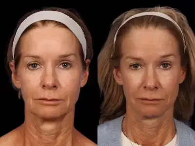 facelift3