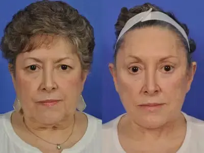 facelift4