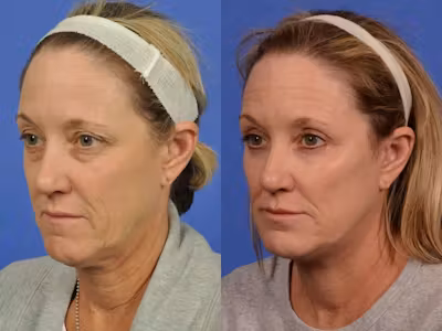 facelift6