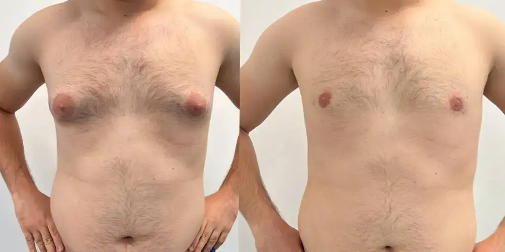 gynecomastia1