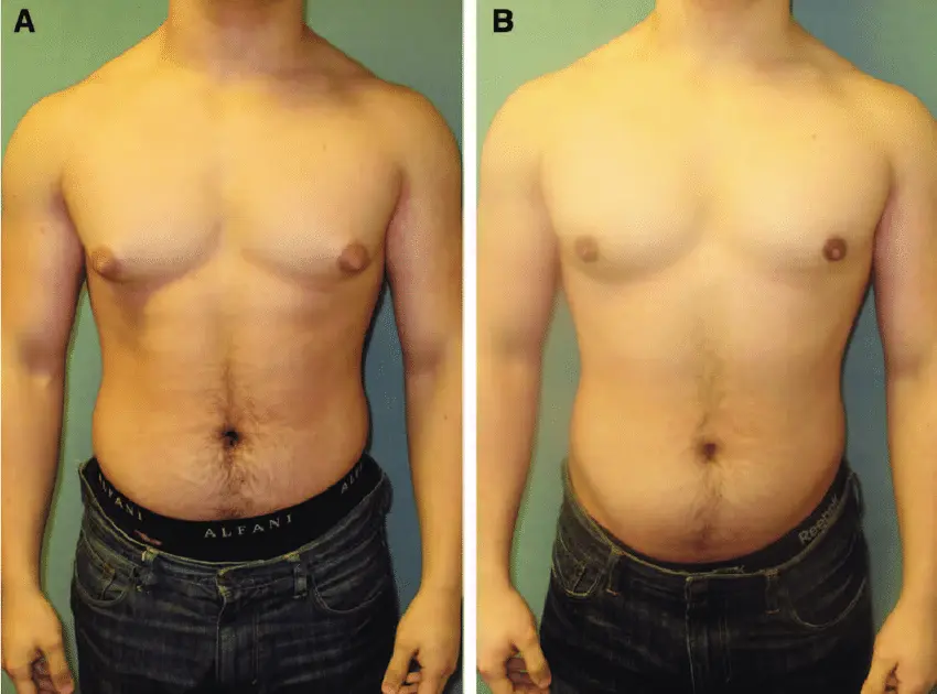 gynecomastia2