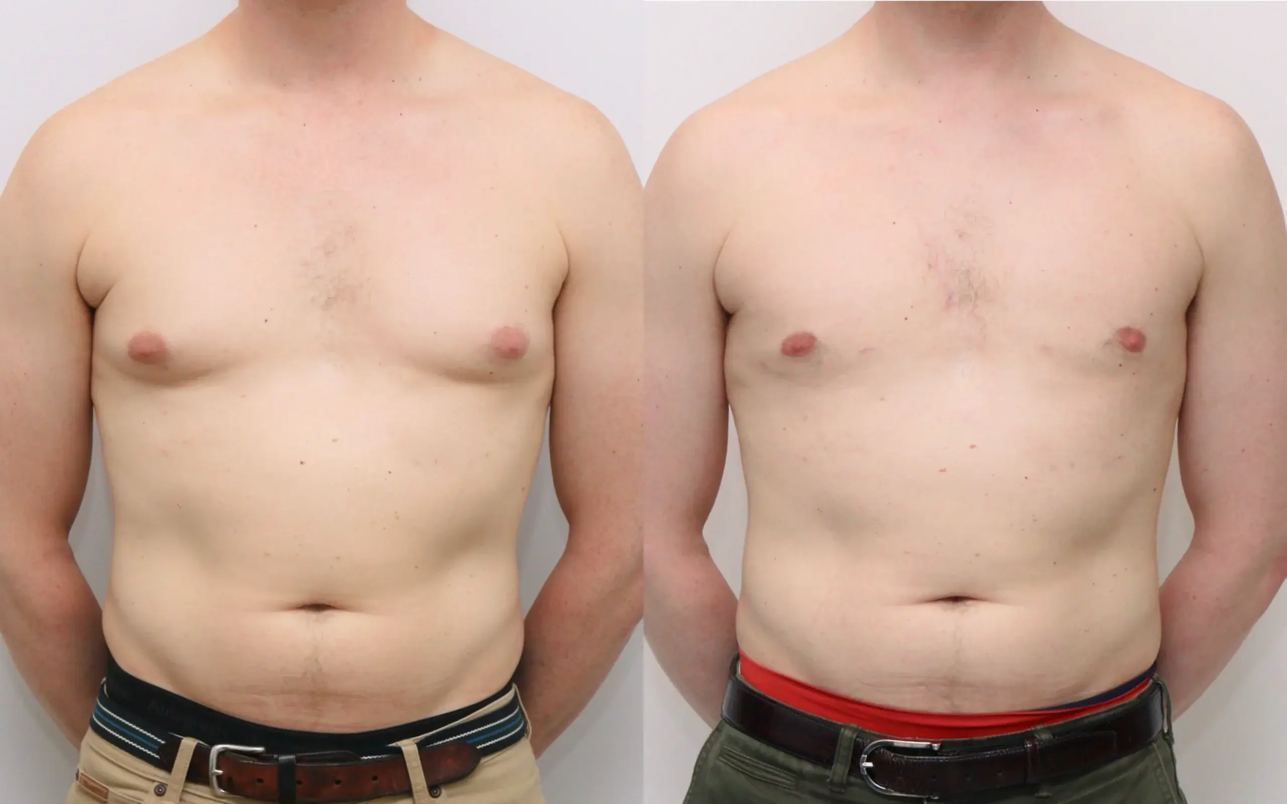 gynecomastia3