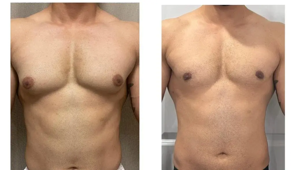gynecomastia4