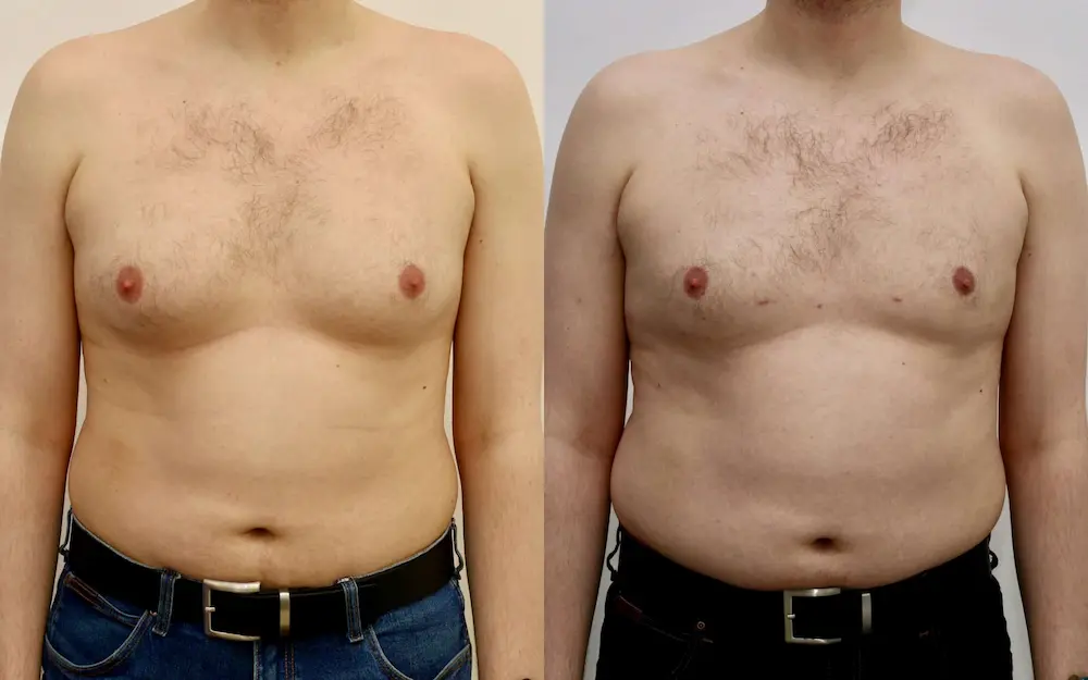 gynecomastia5