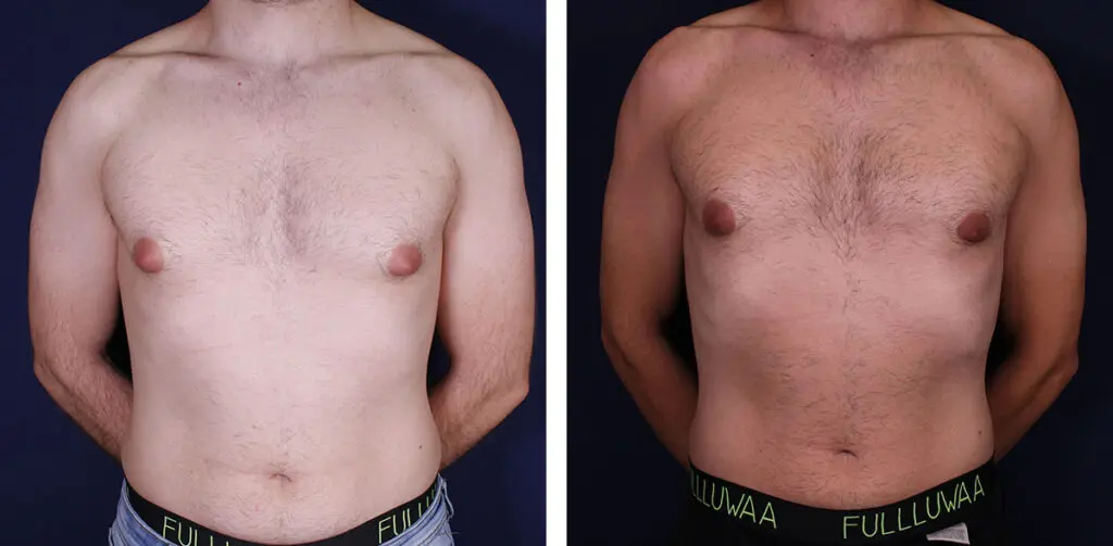 gynecomastia6