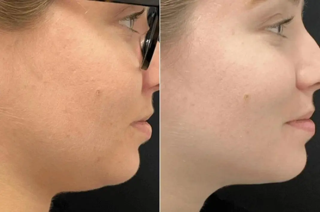 jaw1