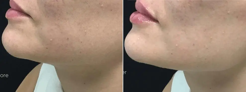 jaw6
