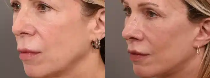 lip5