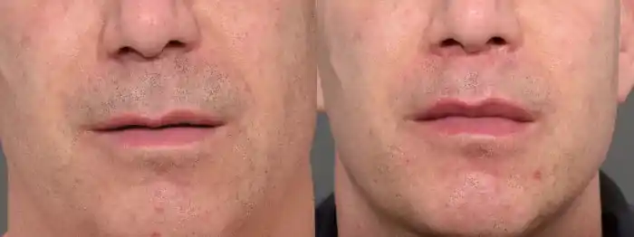 lip6