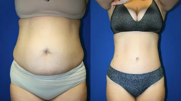 lipo1