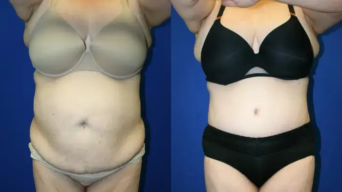 lipo2