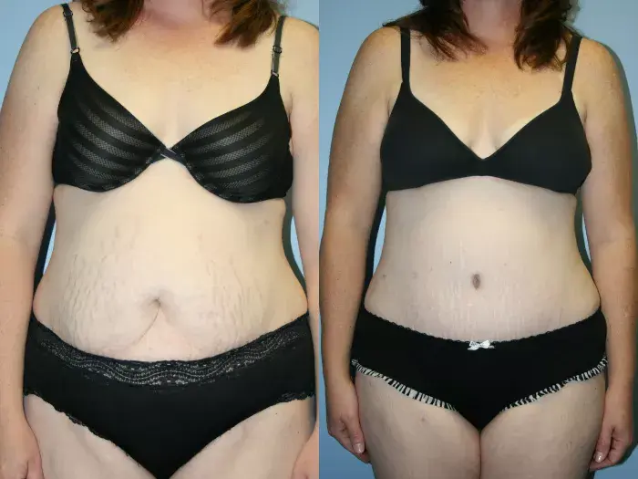 lipo3