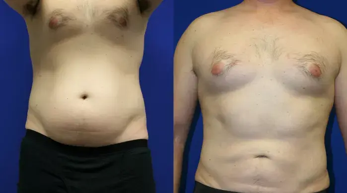 lipo4