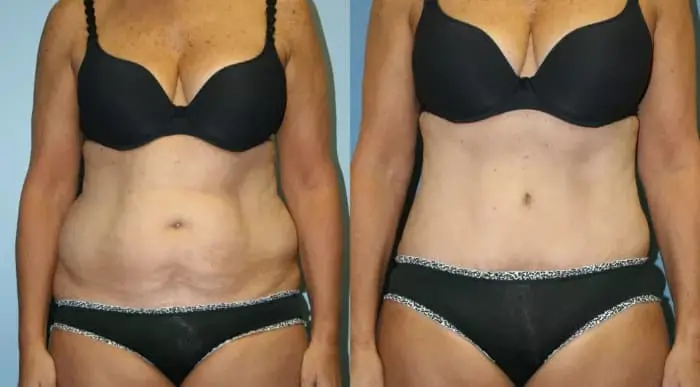 lipo5
