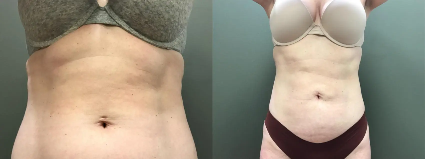 lipo6