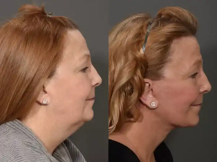 neck1