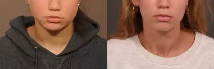 neck3