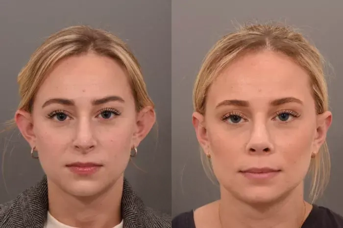 otoplasty1