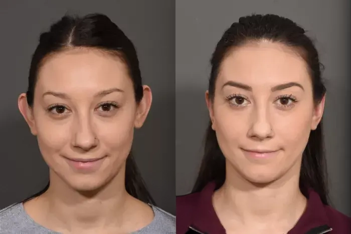 otoplasty2