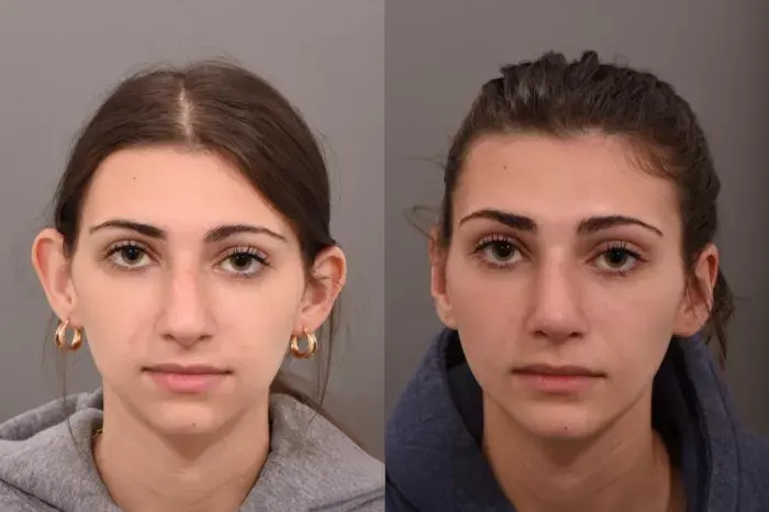 otoplasty3