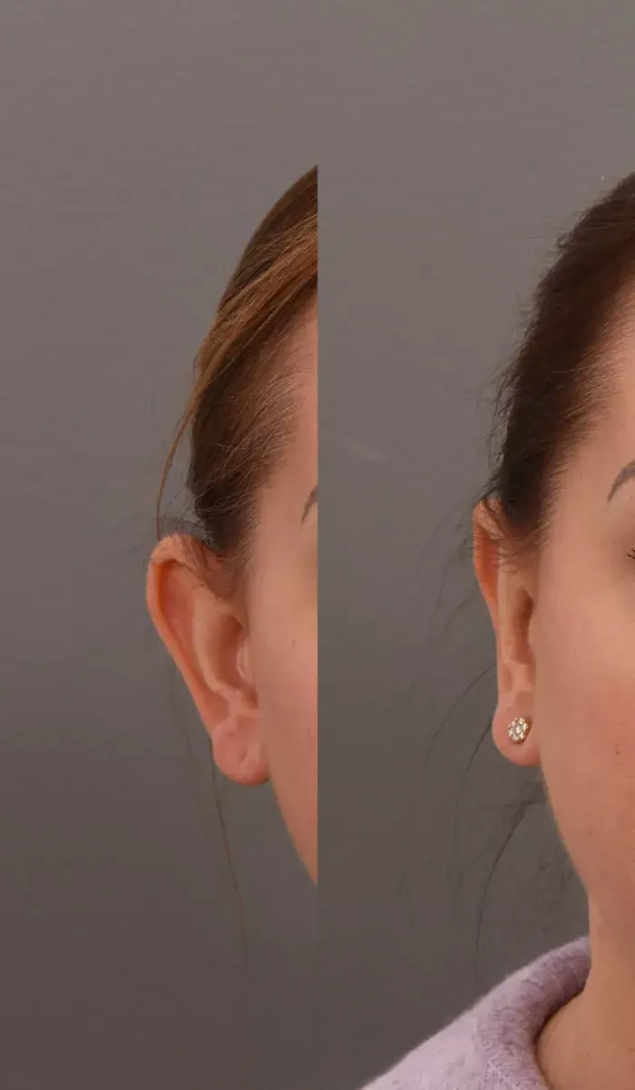 otoplasty4
