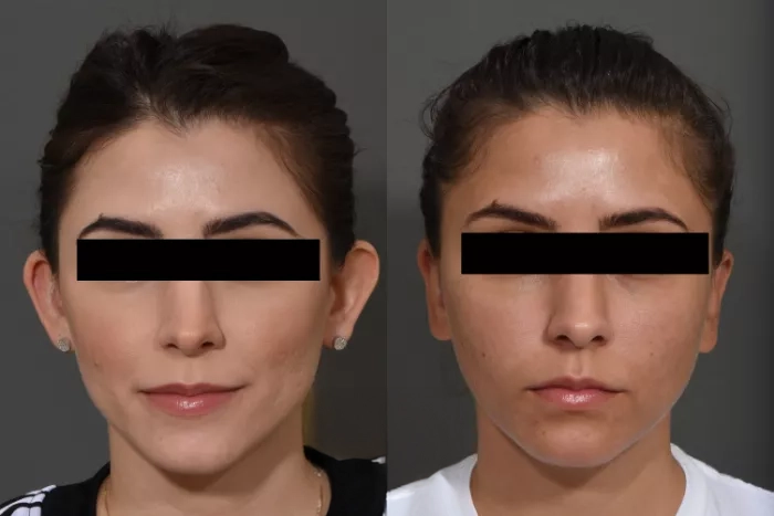 otoplasty6