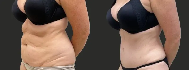 tummy1