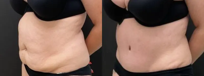 tummy2