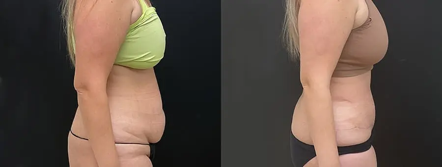 tummy3