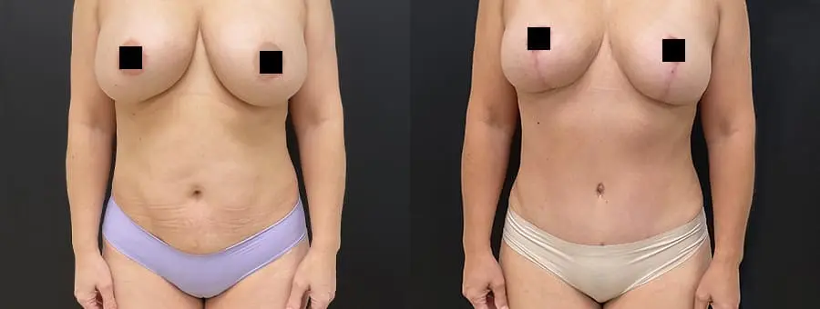 tummy4