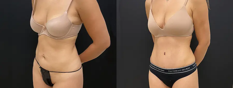 tummy5