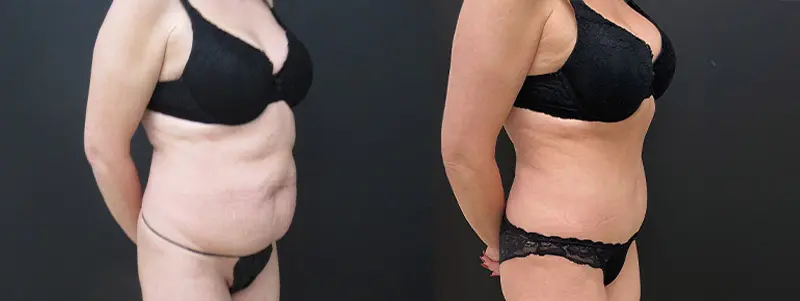 tummy6